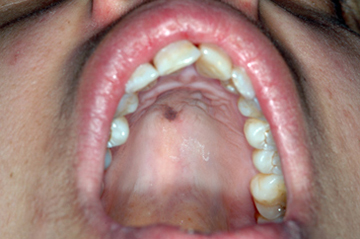 Oral Melanotic Macules 69
